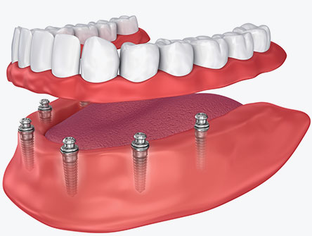 What Are Implant-Supported Hybrid “Dentures”? 