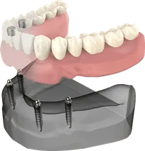 All on 4 dental implants