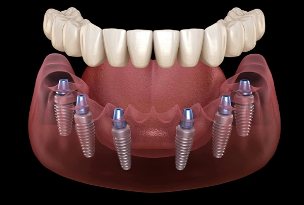 Full dental implant prosthesis with four implants supporting upper denture on model.