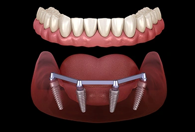 Dental implant prosthetic showing teeth crown above implant fixture system in jawbone.