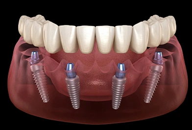 Dental implant model showing prosthetic teeth on implant posts in jawbone replica.