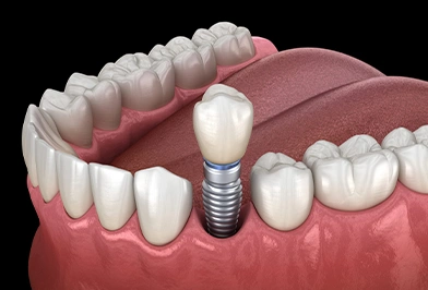 Dental implant illustration showing titanium post anchored in jawbone with crown restoration between natural teeth.