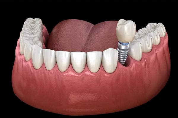Dental implant model showing artificial tooth replacement in jawbone with surrounding natural teeth.