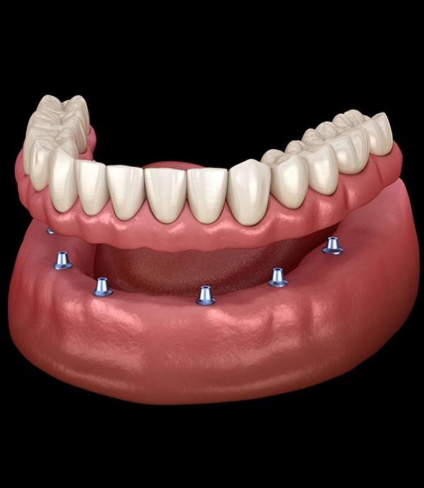 Dental implant model showing jaw structure with multiple implant posts and prosthetic teeth restoration.