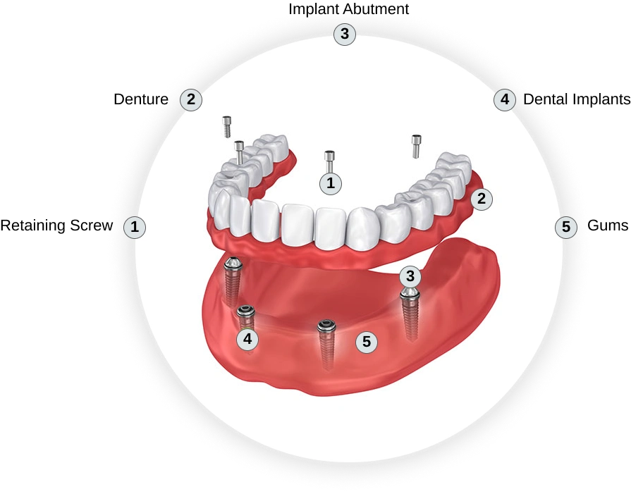 Dental implant diagram showing components including abutment, denture, retaining screw, dental implants, and gums.