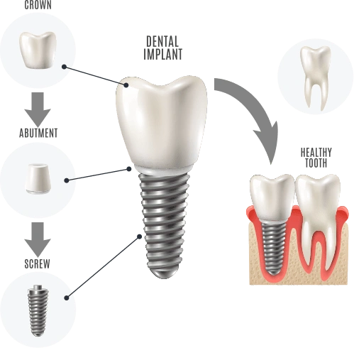 Dental implant diagram showing crown, abutment, screw components and cross-section with healthy tooth.