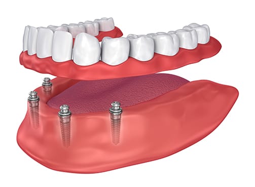 Dental implant bridge prosthesis with titanium posts on red gum model