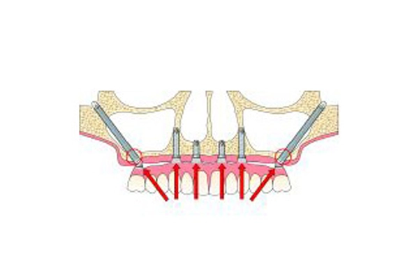 Dental implant diagram showing jaw bone structure with multiple implant posts inserted into gum tissue.