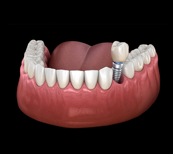 Dental implant model showing tooth replacement with implant screw and crown on gum model.