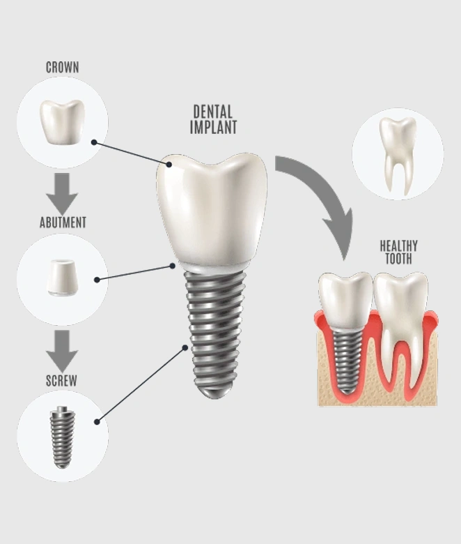 Dental implant diagram showing crown, abutment, screw, and fixture components with cross-section.