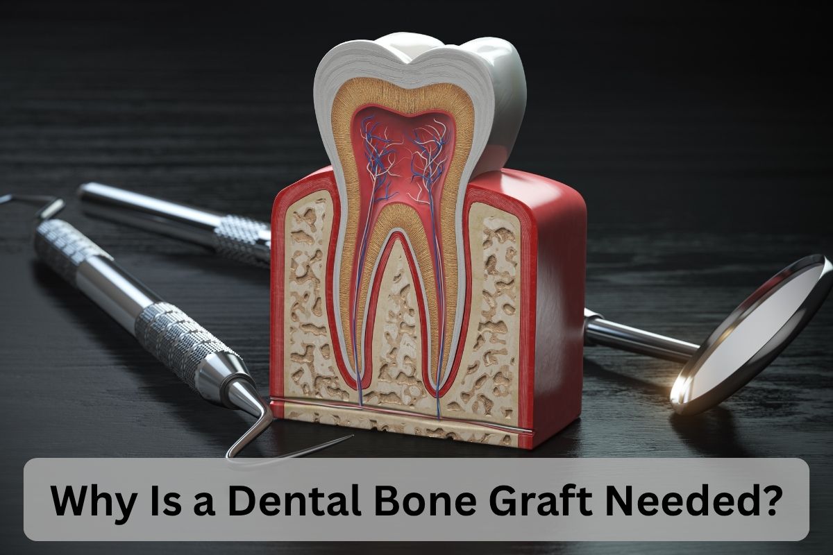 Why do I need a bone graft?
