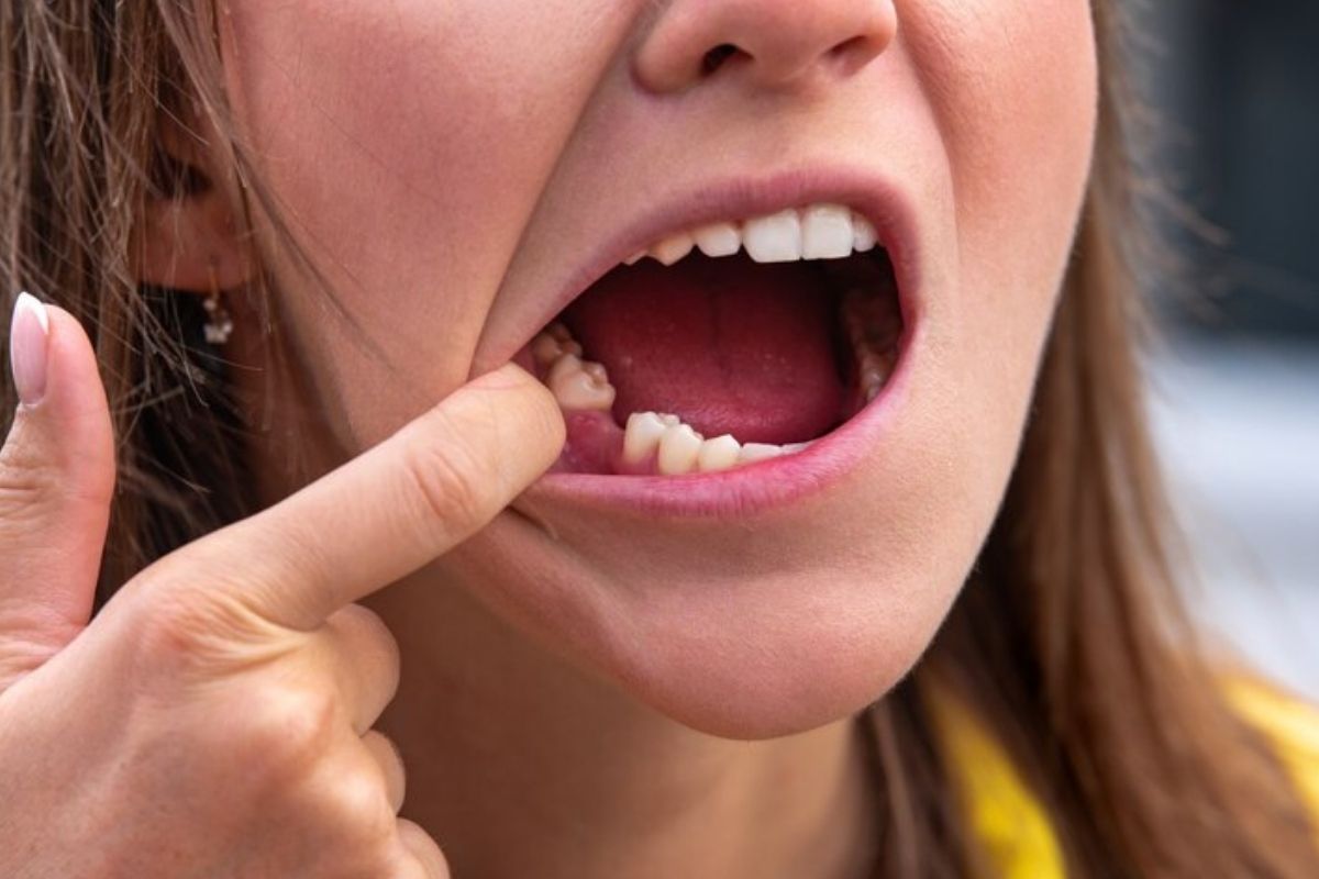 impact of one missing tooth
