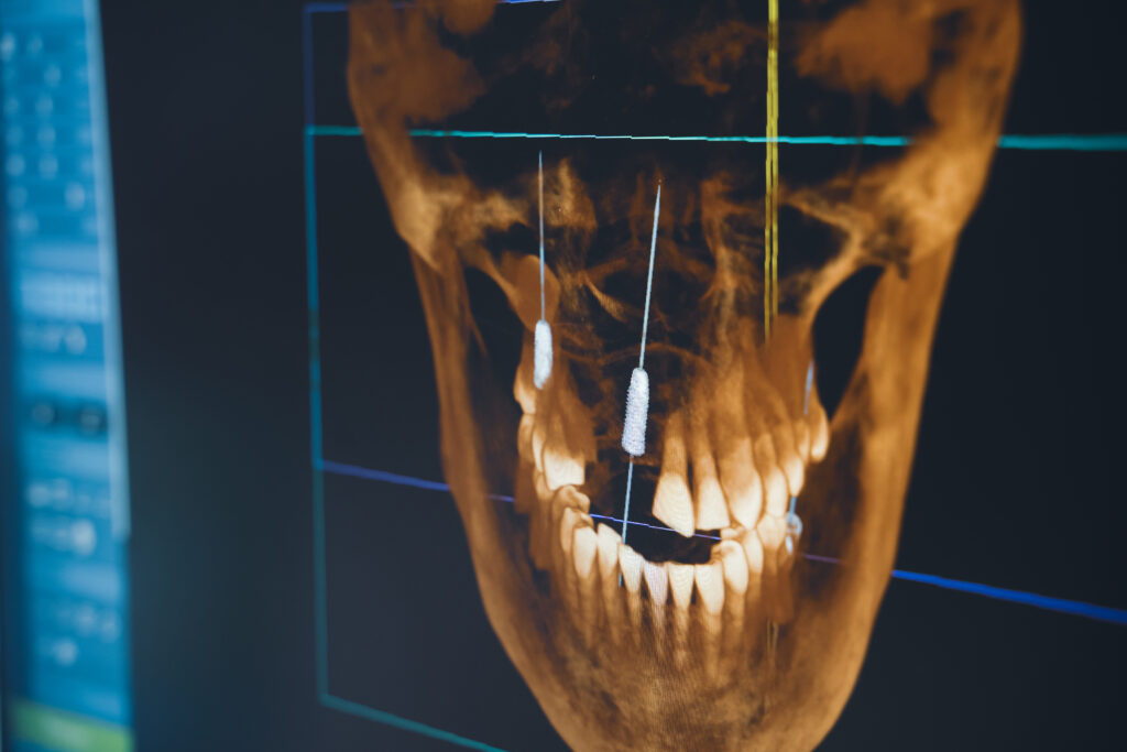 3D jawbone scan for dental implants