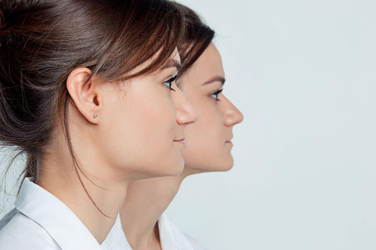 Side profile assessment showing signs that may require Corrective Jaw Surgery